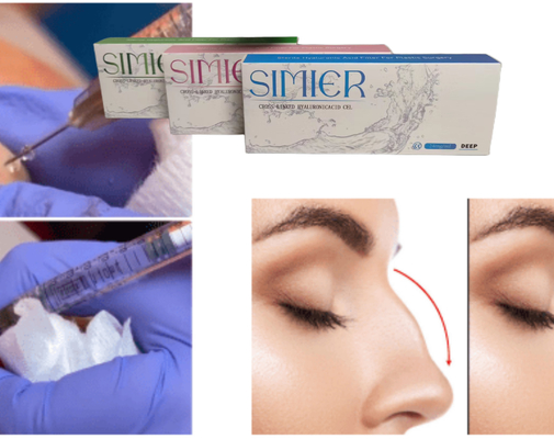 투명 10ml 나트륨 히알루론이트 젤 주사 치료법 미소 줄이를 채우기 위해
