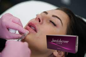 2 * 1ml Juvederm Ultra 3 립 필러 히알루론산 젤 필러
