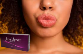 Juvederm Ultra 3 히알루론산 HA 피부 필러 2ml 입술 증강