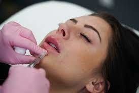 GMP Juvederm Ultra 3 HA 립 Juvederm Vollure를 위한 피부 필러